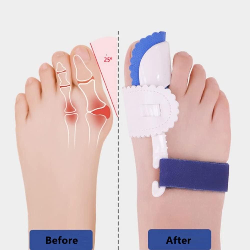 Adjustable Orthopedic Bunion Corrector Splint - Straighten Toes Relieve Pain & Realign Toes Naturally