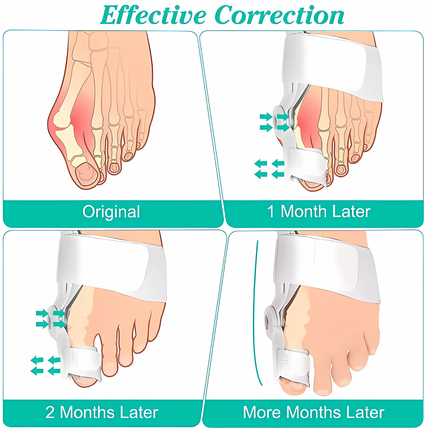 Adjustable Silicone Toe Separator for Adults – Bunion Pain Relief & Toe Alignment Bunion Corrector Splint Kit